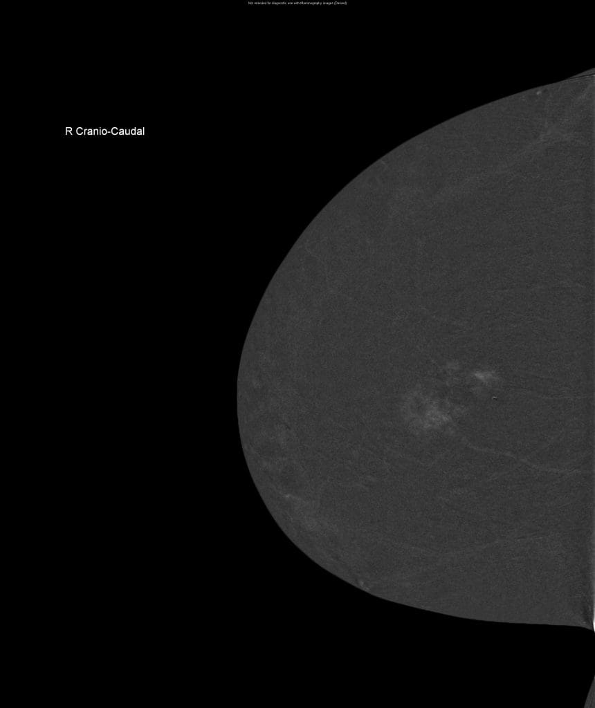 mammogram image using contrast enhanced dye