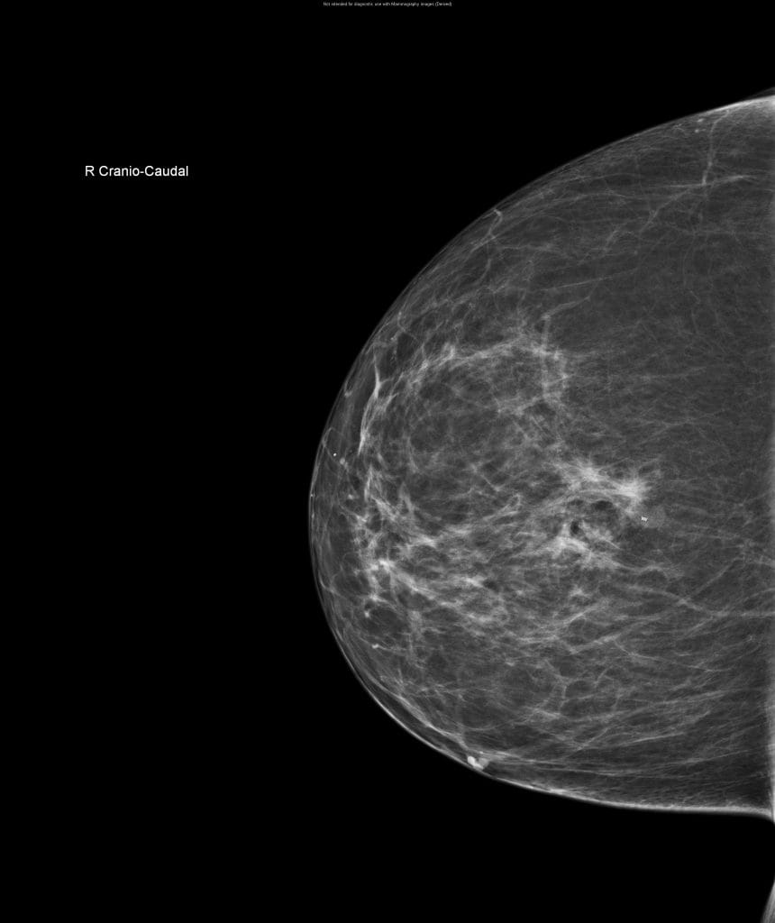 traditional breast mammogram image