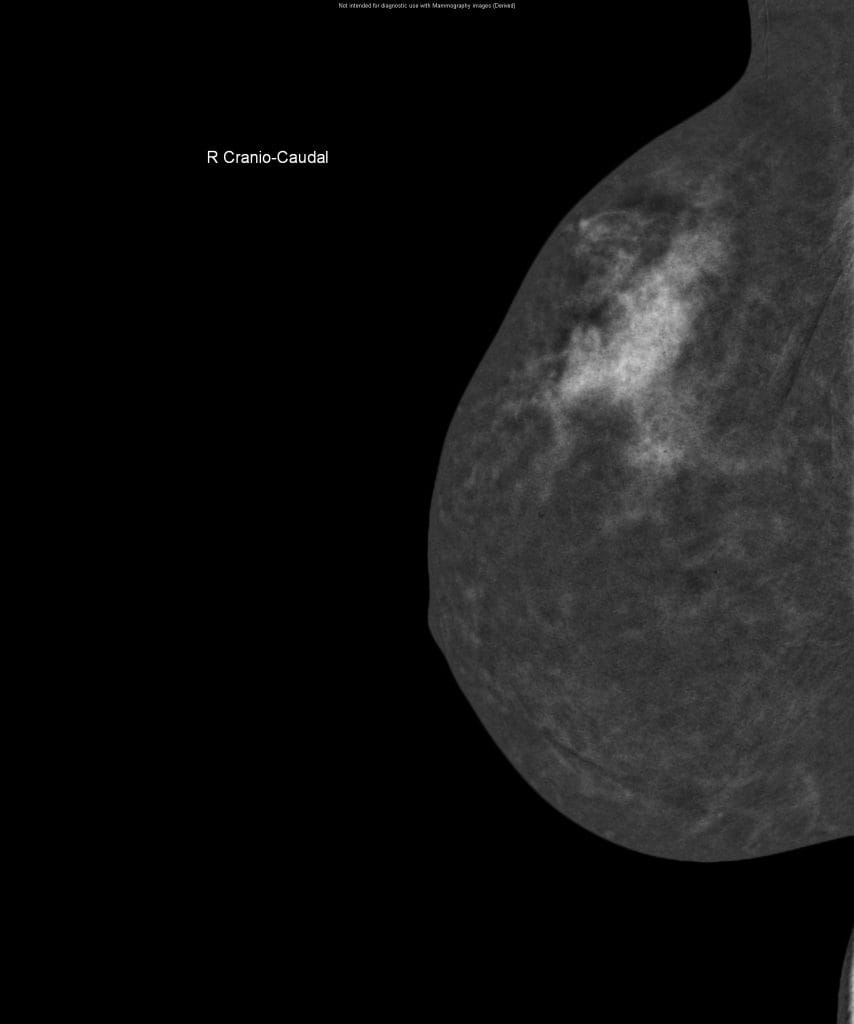 mammogram image with contrast dye