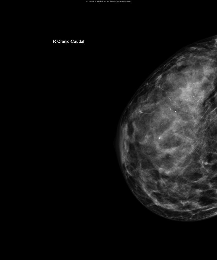 traditional mammogram image